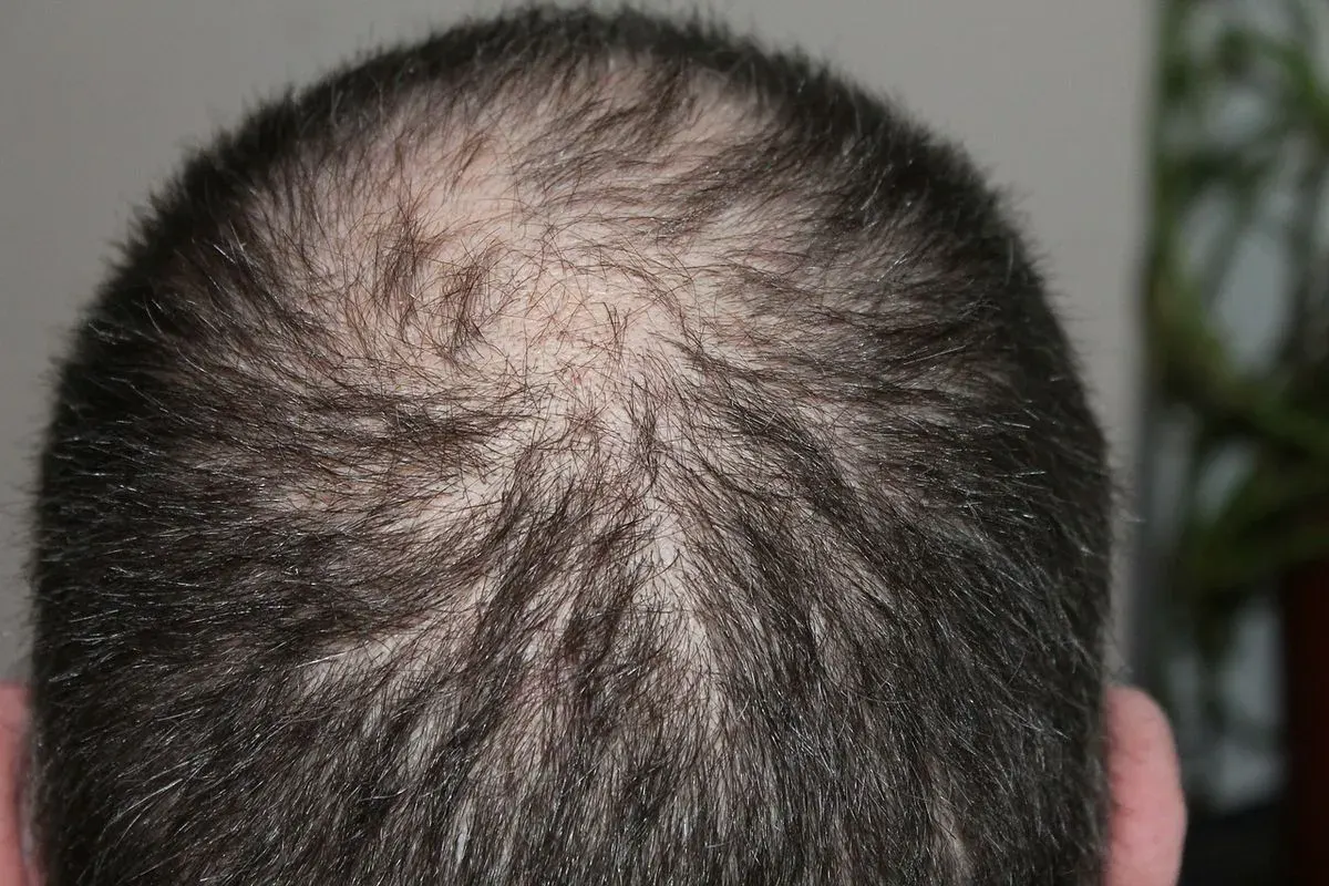 rambut tipis