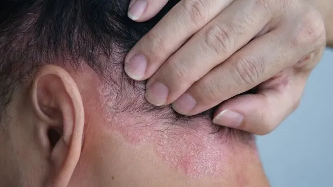 Seborrheic Dermatitis