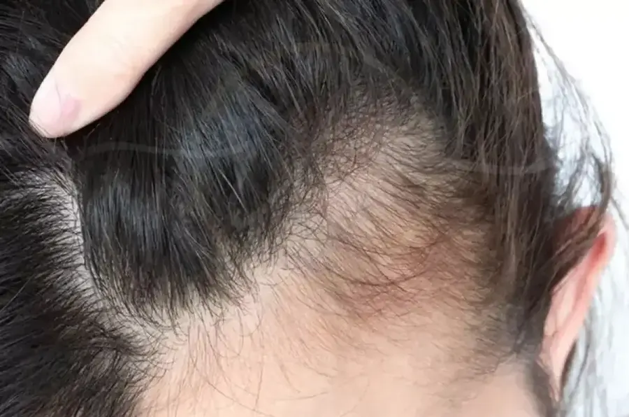 Traction Alopecia