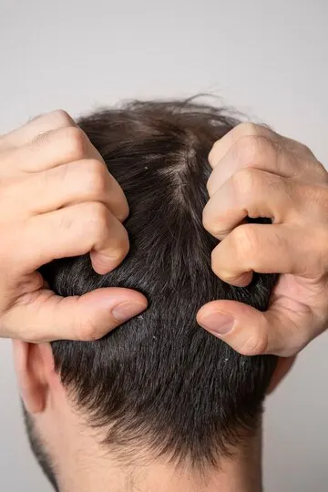 8 Cara Mencegah Ketombe dengan Perawatan Rambut Sehari-hari