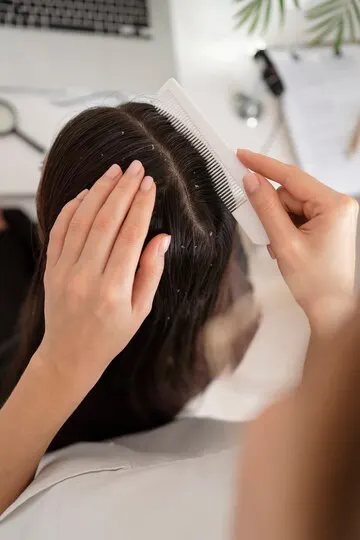 Cara Efektif Mengatasi Ketombe yang Mengganggu Penampilan