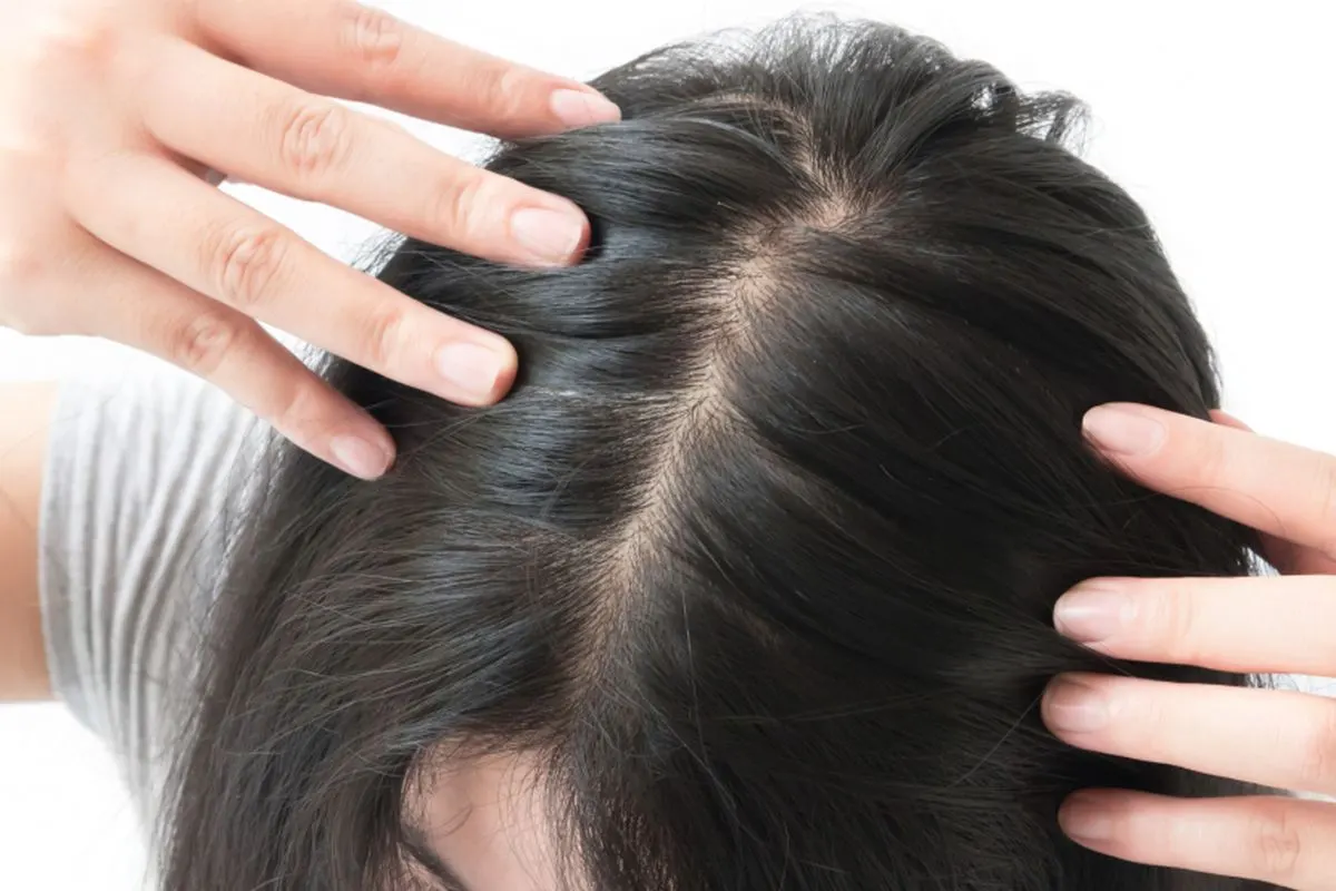 Penyebab Penipisan Rambut: Faktor Internal dan Eksternal yang Perlu Diketahui