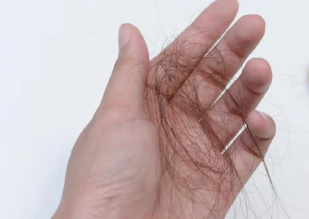 Perawatan Klinis untuk Rambut Rontok: PRP, Laser, hingga Transplantasi