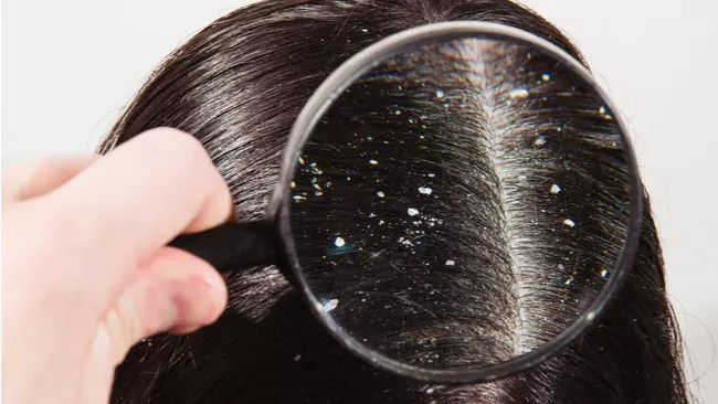Ketombe Rambut Parah? Jangan Panik, Ini Solusinya