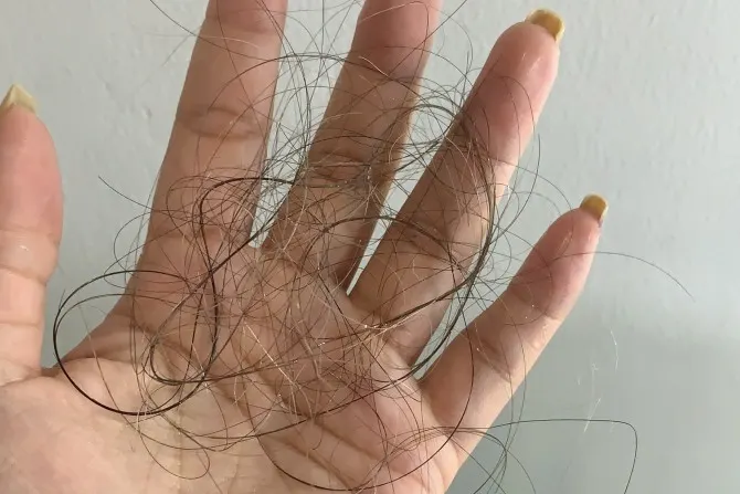 Rambut Rontok karena PCOS? Kenali Penyebab dan Cara Mengatasinya Secara Efektif