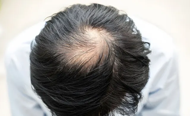 Stres Bisa Bikin Botak? Begini Penjelasan Medis dan Cara Mencegahnya