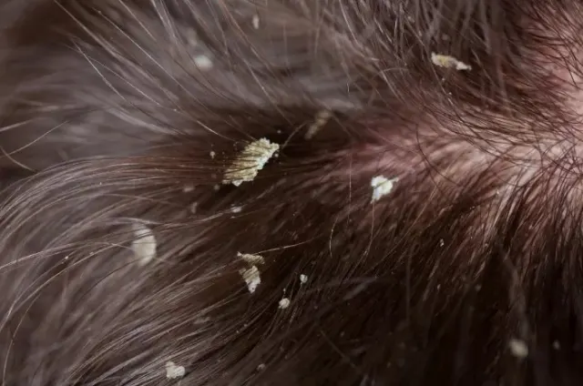 11 Tips Efektif Mencegah Ketombe pada Rambut