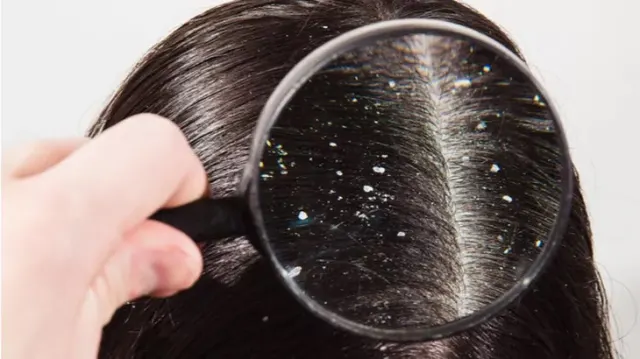 10 Penyebab Ketombe pada Rambut yang Perlu Diketahui