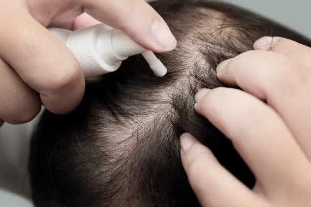 Rambut Tipis? Tenang, Ada Solusinya!