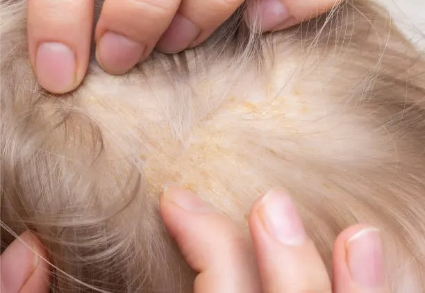 Cara Asyik Mengatasi Kebotakan: Panduan Lengkap untuk Rambut Lebat