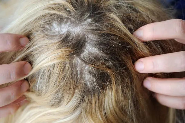 7 Perawatan Khusus untuk Rambut Berketombe: Produk dan Teknik Terbaik