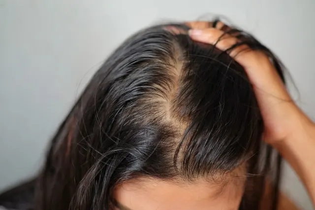 Perawatan Rambut Ketombe untuk Semua Jenis Rambut: Solusi Terbaik