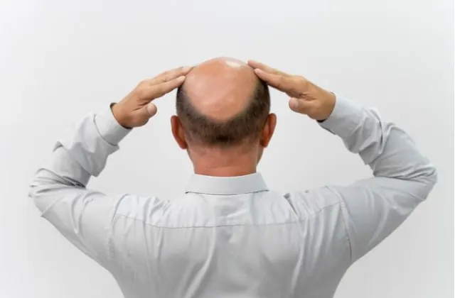 Perawatan Rambut Pria: Mengatasi Kebotakan Dini dan Menjaga Kulit Kepala Sehat