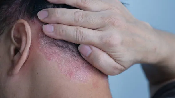 Psoriasis di Kulit Kepala: Bukan Ketombe Biasa!