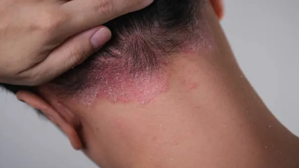 Psoriasis pada Kulit Kepala: Fakta, Mitos, dan Cara Penanganannya